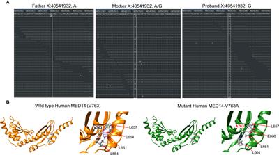 Investigation of the causal etiology in a patient with T-B+NK+ immunodeficiency